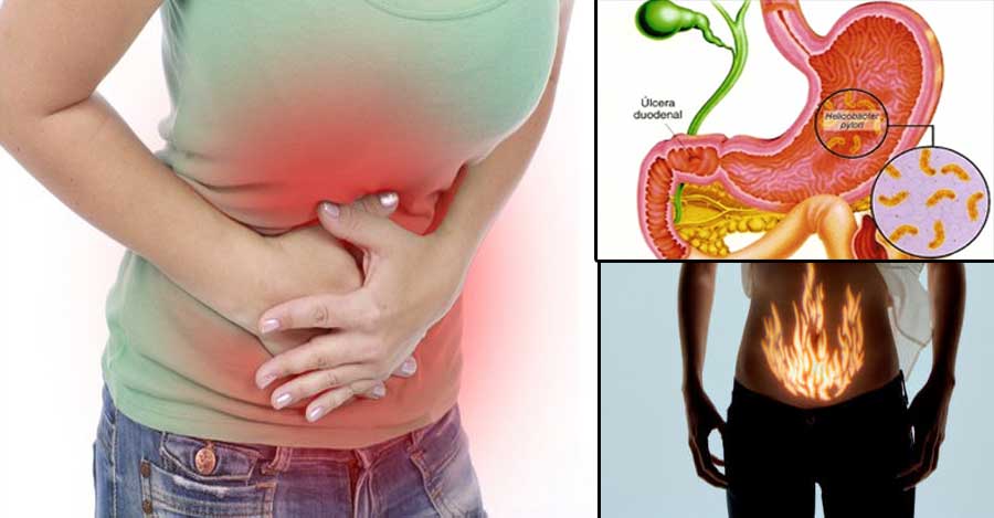 Gastritis Aguda Gastritis Aguda