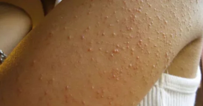 alergia al gluten