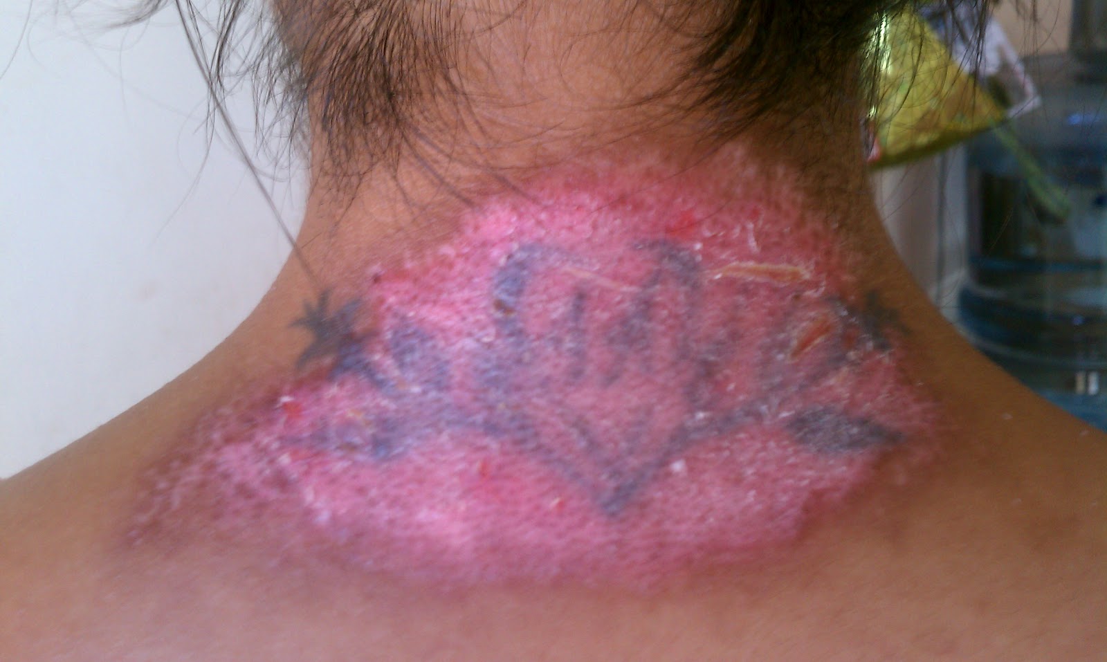 quitar tatuaje quitar tatuaje