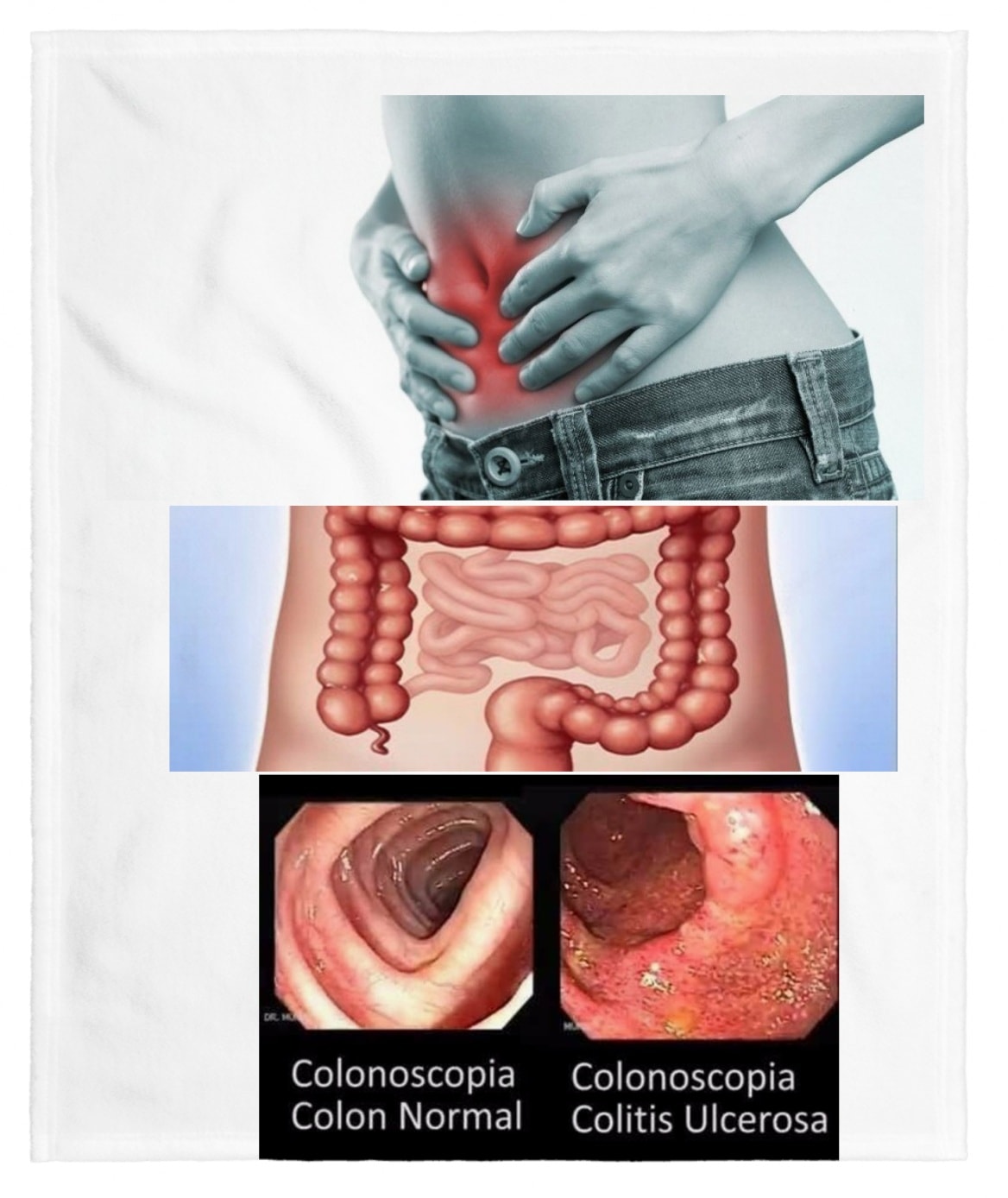Remedios caseros para la colitis - Tipos causas y sintomas